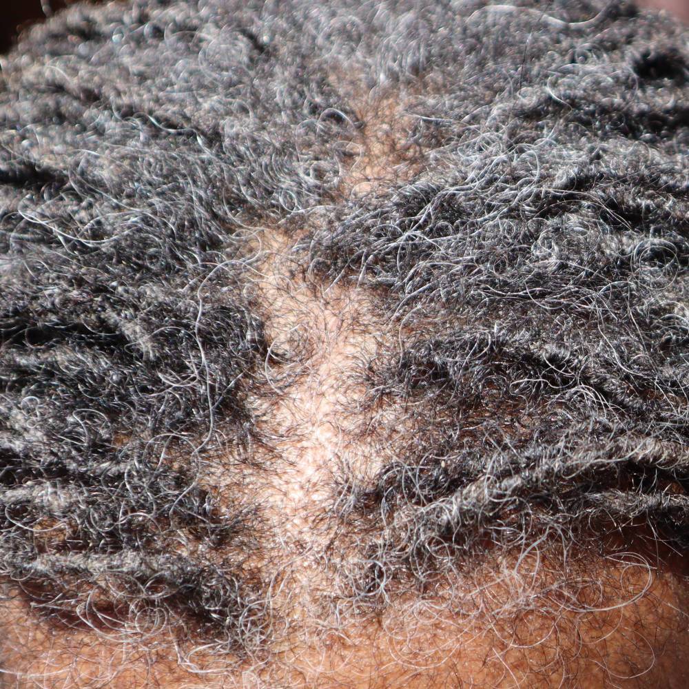 Top view of scalp showing hair thinning before treatment with What Naturals Love Hair Serum. Hydrates and stimulates follicles.