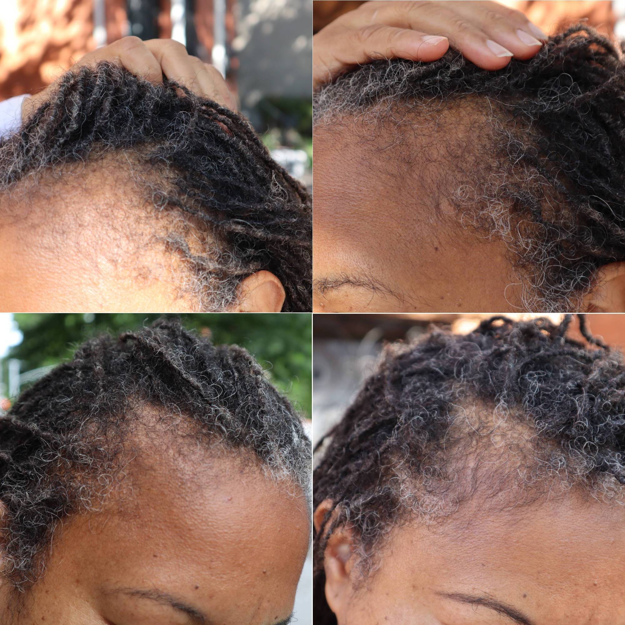 Close-up of hairline before and after using What Naturals Love Hair Serum. Natural treatment for hair loss and scalp hydration.