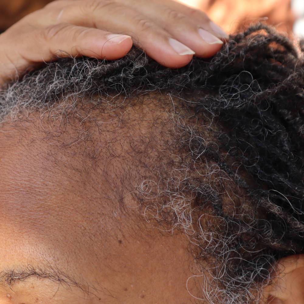 Close-up of thinning hairline before treatment with What Naturals Love Hair Serum. Natural solution for hair loss and hydration.