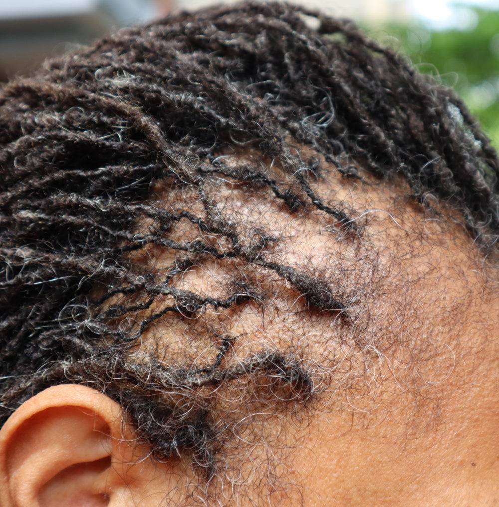 Detailed view of thinning hairline before treatment with What Naturals Love Hair Serum. Hydrates scalp and promotes regrowth.