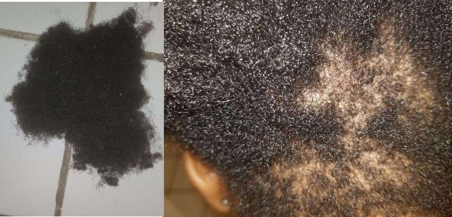 haaruitval door vlechten